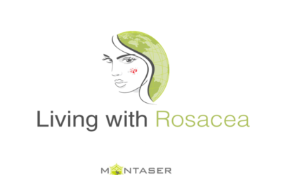 Living with Rosacea